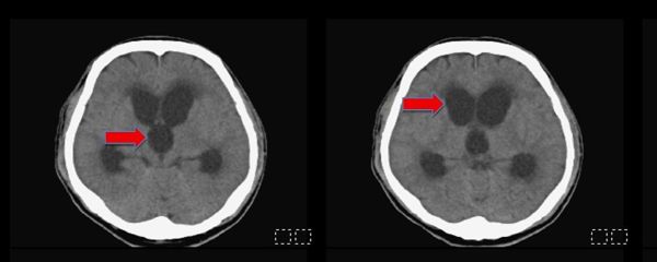 頭部外傷後意識不清嗜睡　留意水腦症造成長期神經功能受損1